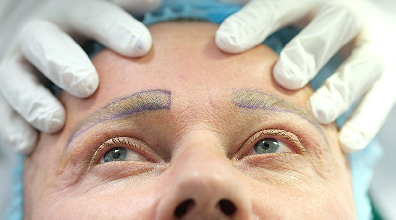 Augenbraun und Wimperntransplantation