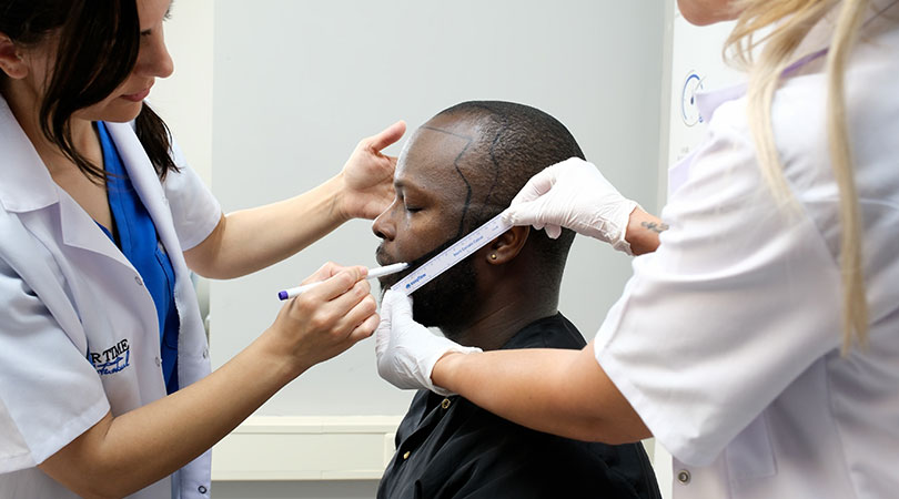 Trasplante de Barba y Bigote