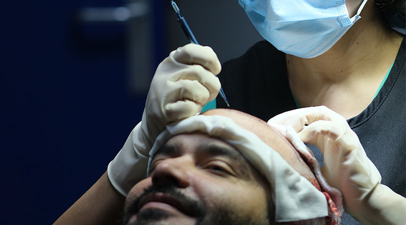 FUE Sapphire Hair Transplant